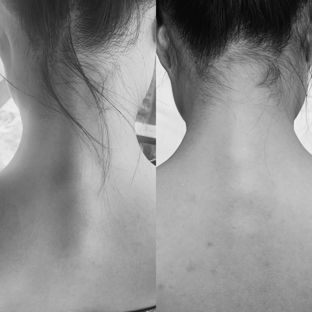 Cervicothoracic Dysfunction in a Golf&nbsp;Enthusiast