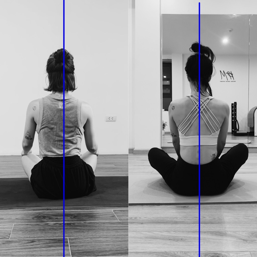 Recurrence of Low Back Pain After 1 Year&nbsp;Symptom-Free