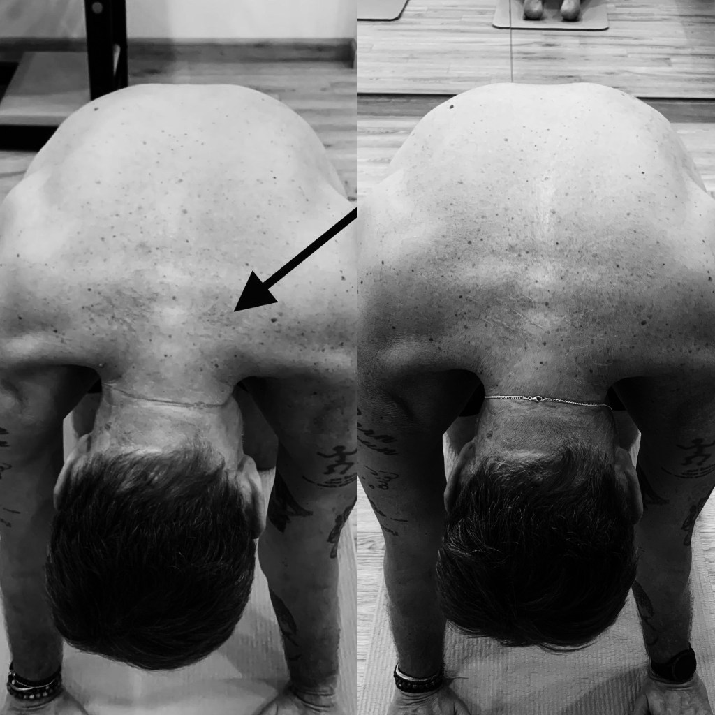 cervico-thoracic region