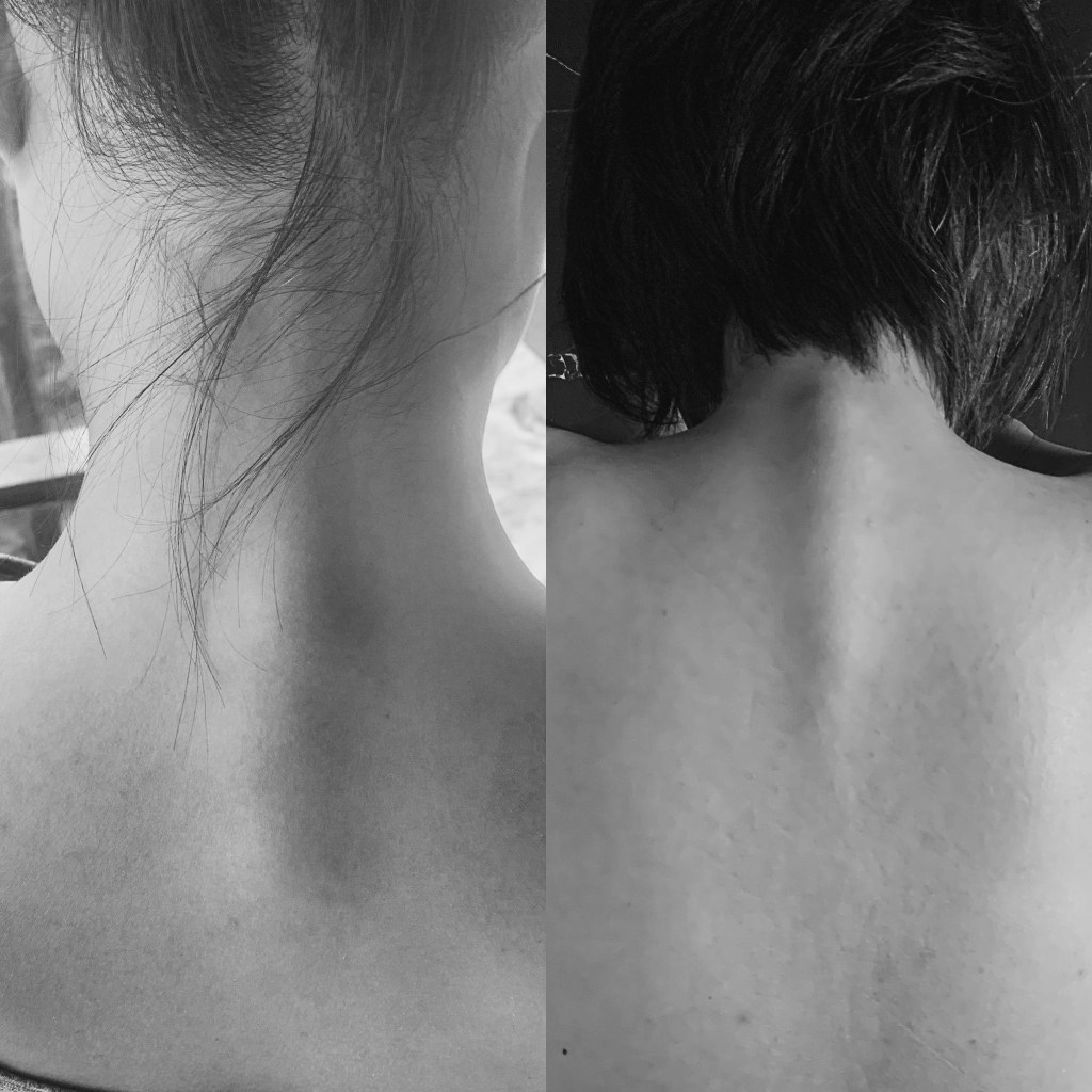 Joint Hypermobility, Pain, and Early Degenerative&nbsp;Change